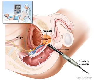 tnm prostate cancer staging uretrita gonococica