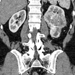 tumores renales, cáncer de riñón, cancer renal, carcinoma de células renales, urologos guatemala