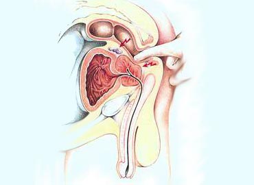 Krónikus urethroprostatitis. sötét vizelet prosztatagyulladásból