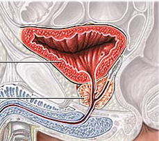 Cáncer de próstata, hiperplasia de próstata, prostatitis