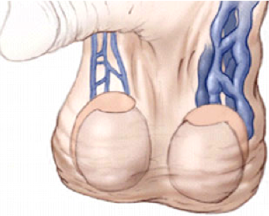 Varicocele o Varices en el testículo, infertilidad factor masculino,