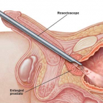 resección de próstata - cirugía de próstata