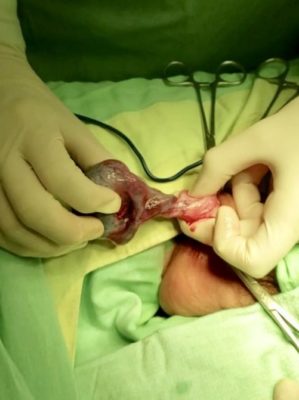 torsión del testículo - exploración testicular